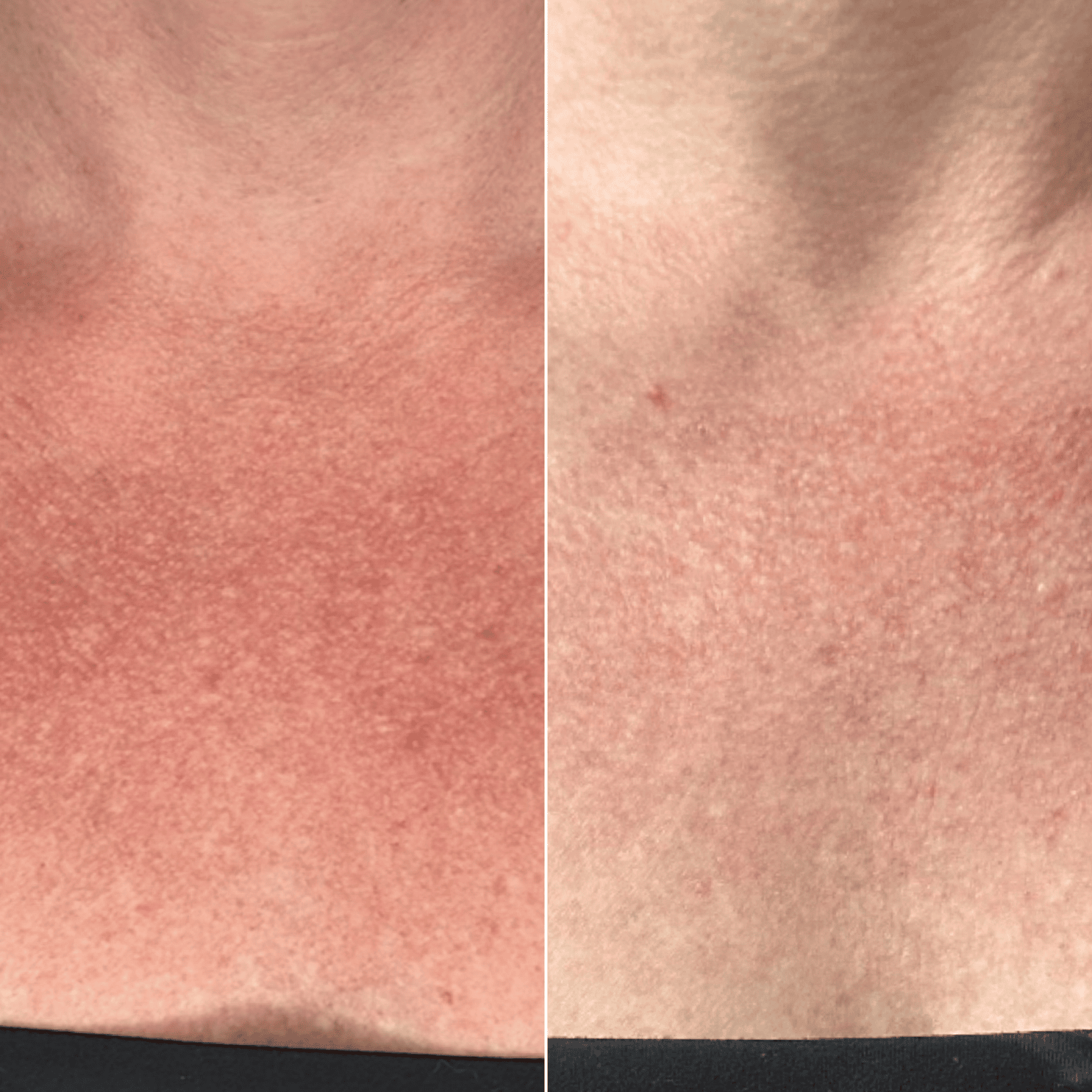 Bryer - Broadband Light (BBL) - Lemmon Avenue Plastic Surgery & Laser ...